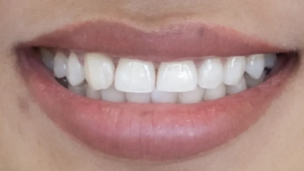 Smile after treatment
