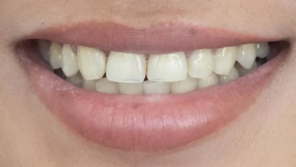 Smile before treatment